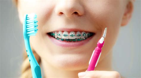 cuidarse los dientes con brackets metalicos|como cuidar los brackets.